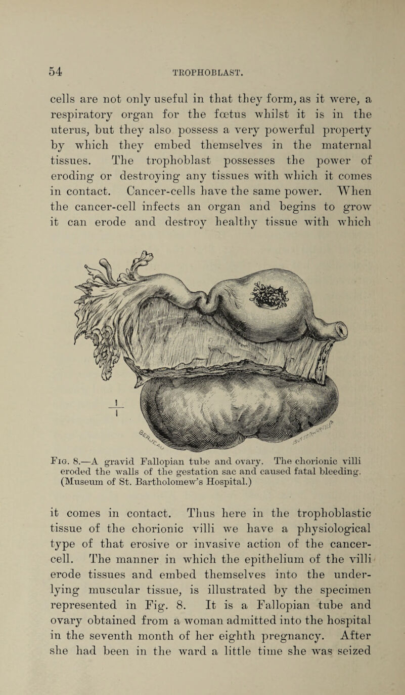 cells are not only useful in that they form, as it were, a respiratory organ for the foetus whilst it is in the uterus, hut they also possess a very powerful property by which they embed themselves in the maternal tissues. The trophoblast possesses the power of eroding or destroying any tissues with which it comes in contact. Cancer-cells have the same power. When the cancer-cell infects an organ and begins to grow it can erode and destroy healthy tissue with which Fig. 8.—A gravid Fallopian tube and ovary. The chorionic villi eroded the walls of the gestation sac and caused fatal bleeding. (Museum of St. Bartholomew’s Hospital.) it comes in contact. Thus here in the trophoblastic tissue of the chorionic villi we have a physiological type of that erosive or invasive action of the cancer¬ cell. The manner in which the epithelium of the villi erode tissues and embed themselves into the under¬ lying muscular tissue, is illustrated by the specimen represented in Fig. 8. It is a Fallopian tube and ovary obtained from a woman admitted into the hospital in the seventh month of her eighth pregnancy. After she had been in the ward a little time she was seized