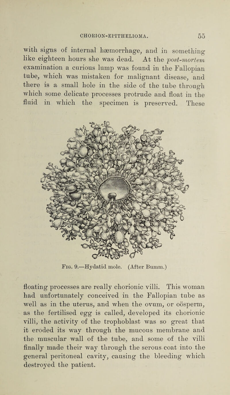 with signs of internal haemorrhage, and in something like eighteen hours she was dead. At the post-mortem examination a carious lump was found in the Fallopian tube, which was mistaken for malignant disease, and there is a small hole in the side of the tube through o which some delicate processes protrude and float in the fluid in which the specimen is preserved. These Fig. 9.—Hydatid mole. (After Bumm.) floating processes are really chorionic villi. This woman had unfortunately conceived in the Fallopian tube as well as in the uterus, and when the ovum, or oosperm, as the fertilised egg is called, developed its chorionic villi, the activity of the trophoblast was so great that it eroded its way through the mucous membrane and the muscular wall of the tube, and some of the villi finally made their way through the serous coat into the general peritoneal cavity, causing the bleeding which destroyed the patient.