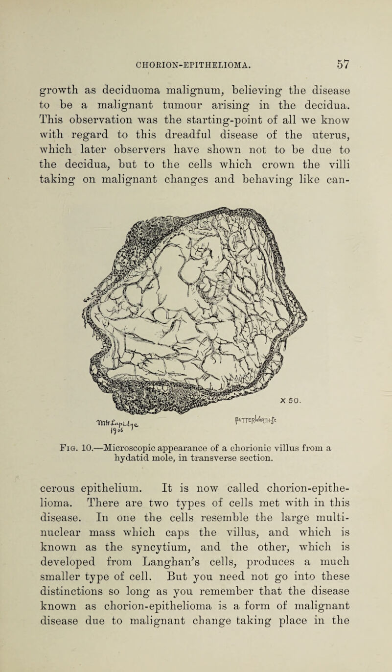 growth as deciduoma malignum, believing the disease to be a malignant tumour arising in the decidua. This observation was the starting-point of all we know with regard to this dreadful disease of the uterus, which later observers have shown not to be due to the decidua, but to the cells which crown the villi taking on malignant changes and behaving like can- Fig. 10.—Microscopic appearance of a chorionic villns from a hydatid mole, in transverse section. cerous epithelium. It is now called chorion-epithe¬ lioma. There are two types of cells met with in this disease. In one the cells resemble the large multi- nuclear mass which caps the villus, and which is known as the syncytium, and the other, which is developed from LanghaiTs cells, produces a much smaller type of cell. But you need not go into these distinctions so long as you remember that the disease known as chorion-epithelioma is a form of malignant disease due to malignant change taking place in the