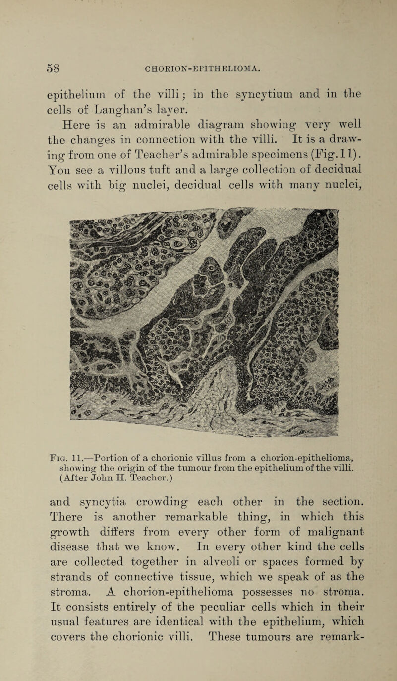 epithelium of the villi; in the syncytium and in the cells of Langhan’s layer. Here is an admirable diagram showing very well the changes in connection with the villi. It is a draw¬ ing from one of Teacher’s admirable specimens (Fig. 11). Yon see a villous tuft and a large collection of decidual cells with big nuclei, decidual cells with many nuclei, Fig. 11.—Portion of a chorionic villus from a chorion-epithelioma, showing the origin of the tumour from the epithelium of the villi. (After John H. Teacher.) and syncytia crowding each other in the section. There is another remarkable thing, in which this growth differs from every other form of malignant disease that we know. In every other kind the cells are collected together in alveoli or spaces formed by strands of connective tissue, which we speak of as the stroma. A chorion-epithelioma possesses no stroma. It consists entirely of the peculiar cells which in their usual features are identical with the epithelium, which covers the chorionic villi. These tumours are remark-