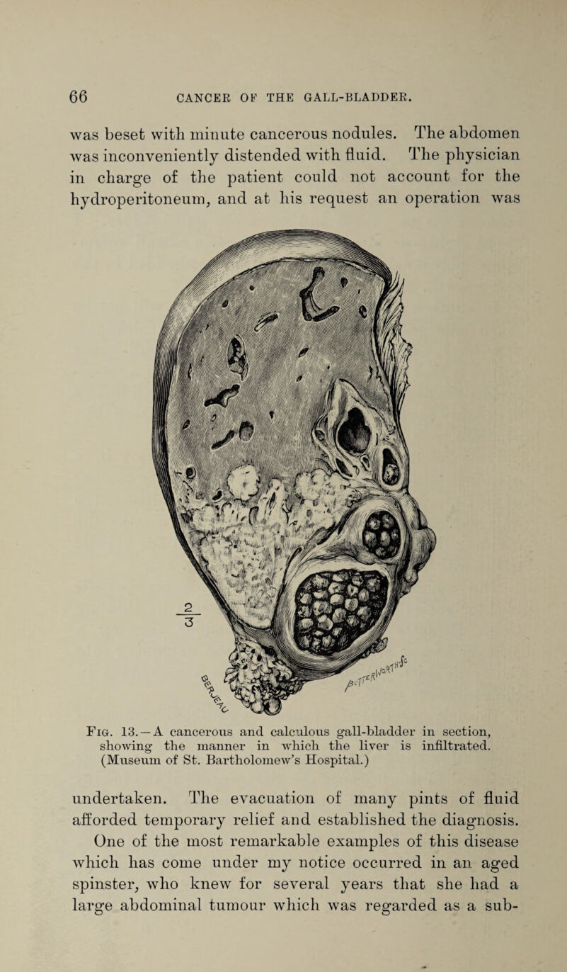 was beset with minute cancerous nodules. The abdomen was inconveniently distended with fluid. The physician in charge of the patient could not account for the hydroperitoneum, and at his request an operation was Fig. 13. —A cancerous and calculous gall-bladder in section, showing the manner in which the liver is infiltrated. (Museum of St. Bartholomew’s Hospital.) undertaken. The evacuation of many pints of fluid afforded temporary relief and established the diagnosis. One of the most remarkable examples of this disease which has come under my notice occurred in an aged spinster, who knew for several years that she had a large abdominal tumour which was regarded as a sub-