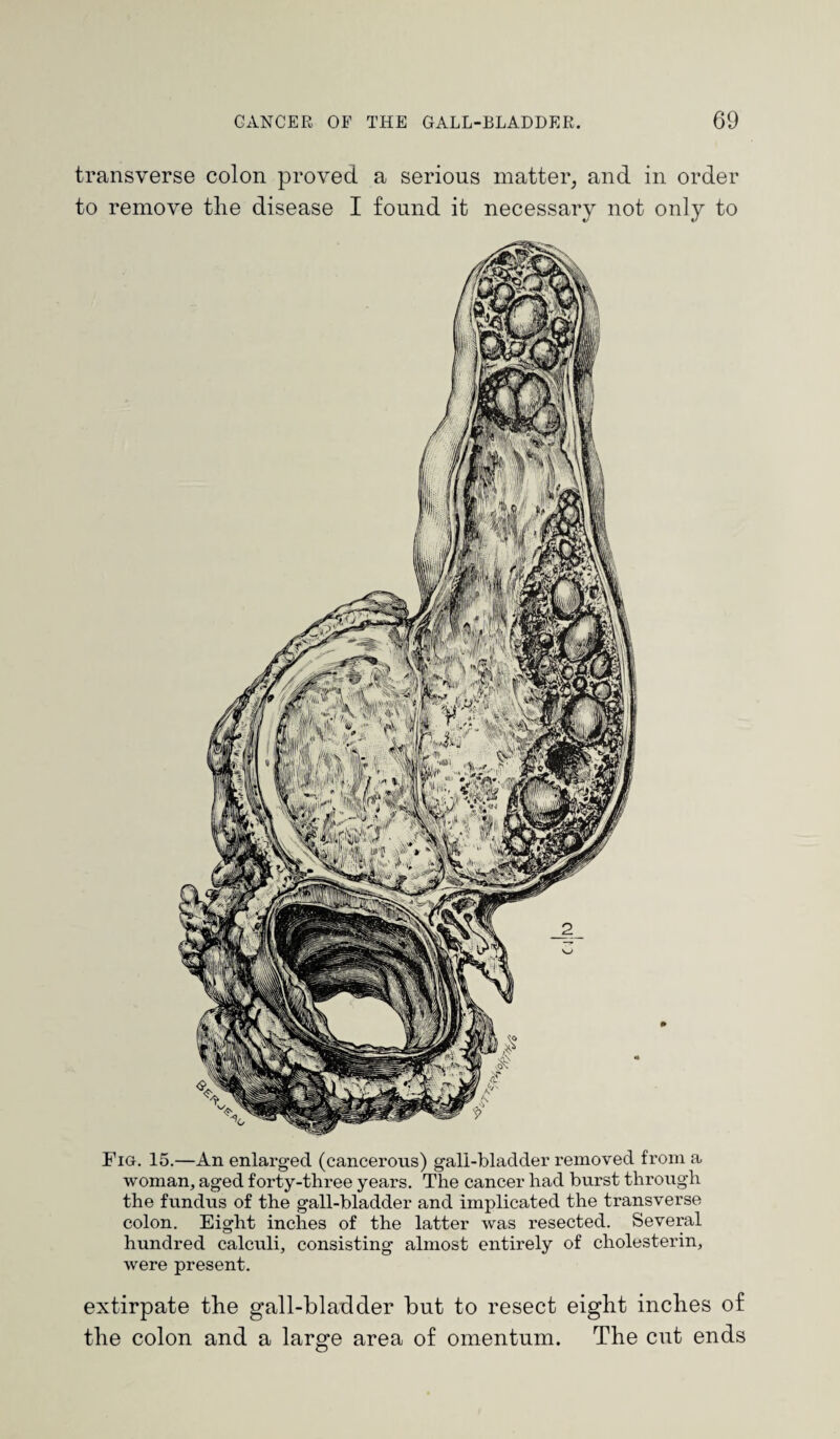 transverse colon proved a serious matter, and in order to remove the disease I found it necessary not only to Fig. 15.—An enlarged (cancerous) gall-bladder removed from a woman, aged forty-three years. The cancer had burst through the fundus of the gall-bladder and implicated the transverse colon. Eight inches of the latter was resected. Several hundred calculi, consisting almost entirely of cholesterin, were present. extirpate the gall-bladder but to resect eight inches of the colon and a large area of omentum. The cut ends