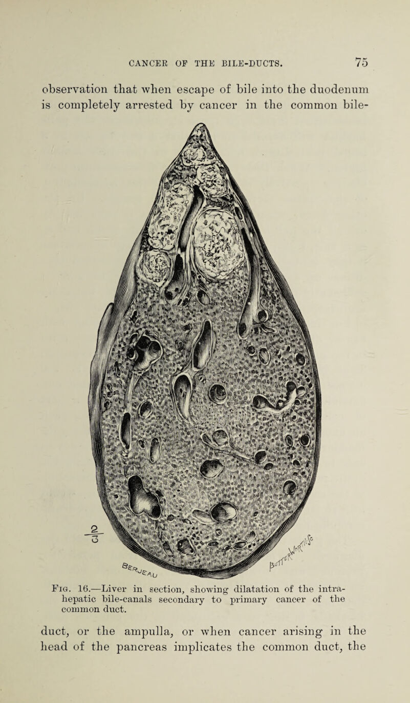 observation that when escape of bile into the duodenum is completely arrested by cancer in the common bile- Fig. 16.—Liver in section, showing dilatation of the intra- hepatic bile-canals secondary to primary cancer of the common duct. duct, or the ampulla, or when cancer arising in the head of the pancreas implicates the common duct, the