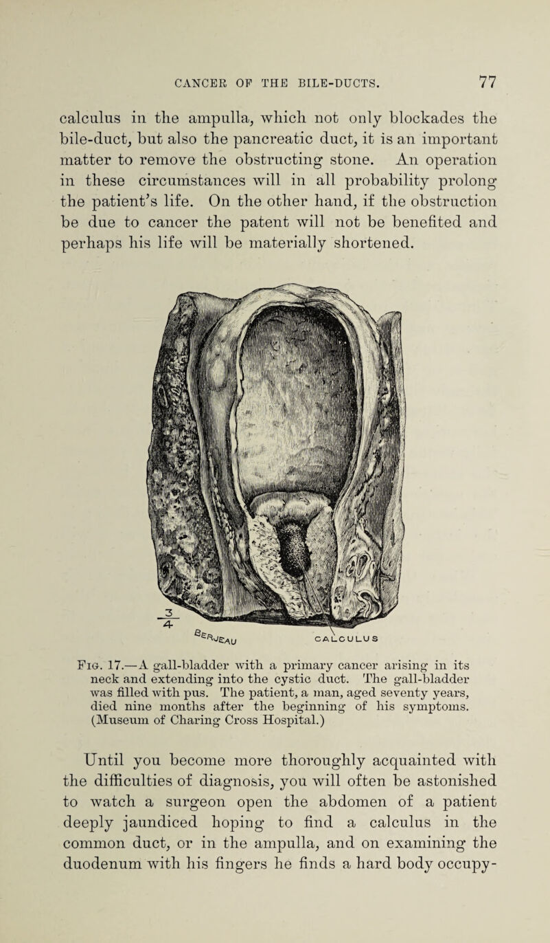 calculus in the ampulla, which not only blockades the bile-duct, but also the pancreatic duct, it is an important matter to remove the obstructing stone. An operation in these circumstances will in all probability prolong the patient’s life. On the other hand, if the obstruction be due to cancer the patent will not be benefited and perhaps his life will be materially shortened. Fig. 17.—A gall-bladder with a primary cancer arising in its neck and extending into the cystic duct. The gall-bladder was filled with pus. The patient, a man, aged seventy years, died nine months after the beginning of his symptoms. (Museum of Charing Cross Hospital.) Until you become more thoroughly acquainted with the difficulties of diagnosis, you will often be astonished to watch a surgeon open the abdomen of a patient deeply jaundiced hoping to find a calculus in the common duct, or in the ampulla, and on examining the duodenum with his fingers he finds a hard body occupy-