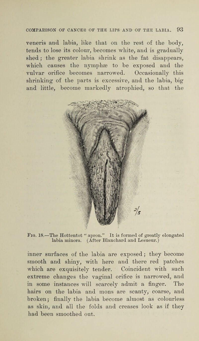 veneris and labia, like that on the rest of the body, tends to lose its colour, becomes white, and is gradually shed; the greater labia shrink as the fat disappears, which causes the nymphge to be exposed and the vulvar orifice becomes narrowed. Occasionally this shrinking of the parts is excessive, and the labia, big and little, become markedly atrophied, so that the Fig. 18.—The Hottentot “ apron.” It is formed of greatly elongated labia minora. (After Blanchard and Lesueur.) inner surfaces of the labia are exposed; they become smooth and shiny, with here and there red patches which are exquisitely tender. Coincident with such extreme changes the vaginal orifice is narrowed, and in some instances will scarcely admit a finger. The hairs on the labia and mons are scanty, coarse, and broken; finally the labia become almost as colourless as skin, and all the folds and creases look as if they had been smoothed out.