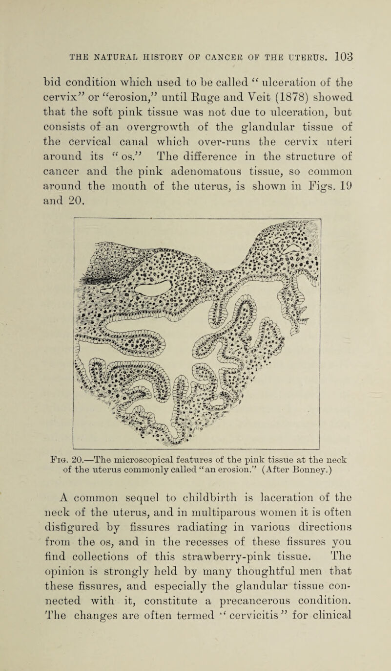 bid condition wliicli used to be called “ ulceration of tlie cervix” or “erosion,” until Ruge and Veit (1878) showed that the soft pink tissue was not due to ulceration, but consists of an overgrowth of the glandular tissue of the cervical canal which over-runs the cervix uteri around its “ os.” The difference in the structure of cancer and the pink adenomatous tissue, so common around the mouth of the uterus, is shown in Figs. 19 and 20. Fig. 20.—The microscopical features of the pink tissue at the neck of the uterus commonly called “an erosion.” (After Bonney.) A common sequel to childbirth is laceration of the neck of the uterus, and in multiparous women it is often disfigured by fissures radiating in various directions from the os, and in the recesses of these fissures you find collections of this strawberry-pink tissue. The opinion is strongly held by many thoughtful men that these fissures, and especially the glandular tissue con¬ nected with it, constitute a precancerous condition. The changes are often termed “cervicitis” for clinical