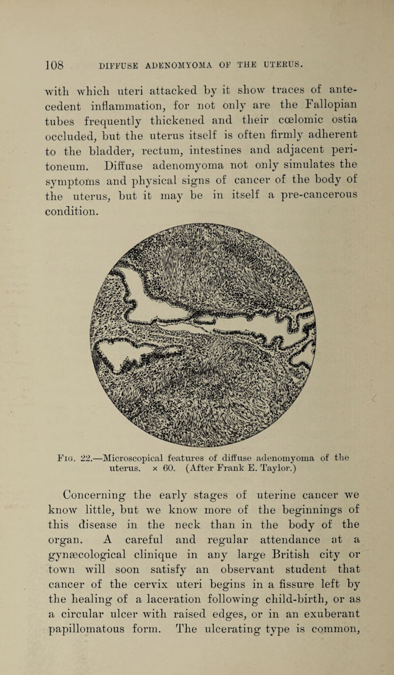 with which uteri attached by it show traces of ante¬ cedent inflammation, for not only are the Fallopian tubes frequently thickened and their ccelomic ostia occluded, but the uterus itself is often firmly adherent to the bladder, rectum, intestines and adjacent peri¬ toneum. Diffuse adenomyoma not only simulates the symptoms and physical signs of cancer of the body of the uterus, but it may be in itself a pre-cancerous condition. Fig. 22.—Microscopical features of diffuse adenomyoma of tlie uterus, x 60. (After Frank E. Taylor.) Concerning the early stages of uterine cancer we know little, but we know more of the beginnings of this disease in the neck than in the body of the organ. A careful and regular attendance at a gynascological clinique in any large British city or town will soon satisfy an observant student that cancer of the cervix uteri begins in a fissure left by the healing of a laceration following child-birth, or as a circular ulcer with raised edges, or in an exuberant papillomatous form. The ulcerating type is common,