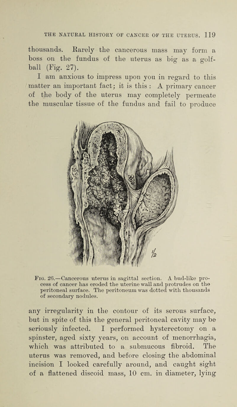 thousands. Karely the cancerous mass may form a boss on the fundus of the uterus as big as a golf- ball (Fig. 27). I am anxious to impress upon you in regard to this matter an important fact; it is this : A primary cancer of the body of the uterus may completely permeate the muscular tissue of the fundus and fail to produce Fig. 26.—Cancerous uterus in sagittal section. A bud-like pro¬ cess of cancer has eroded the uterine wall and protrudes on the peritoneal surface. The peritoneum was dotted with thousands of secondary nodules. any irregularity in the contour of its serous surface, but in spite of this the general peritoneal cavity may be seriously infected. I performed hysterectomy on a spinster, aged sixty years, on account of menorrhagia, which was attributed to a submucous fibroid. The uterus was removed, and before closing the abdominal incision I looked carefully around, and caught sight of a flattened discoid mass, 10 cm. in diameter, lying*