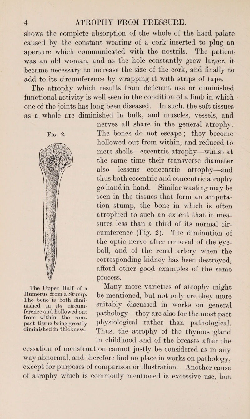 U 1% &> taftill 4 ATROPHY FROM PRESSURE. shows the complete absorption of the whole of the hard palate caused by the constant wearing of a cork inserted to plug an aperture which communicated with the nostrils. The patient was an old woman, and as the hole constantly grew larger, it became necessary to increase the size of the cork, and finally to add to its circumference by wrapping it with strips of tape. The atrophy which results from deficient use or diminished functional activity is well seen in the condition of a limb in which one of the joints has long been diseased. In such, the soft tissues as a whole are diminished in bulk, and muscles, vessels, and nerves all share in the general atrophy. hollowed out from within, and reduced to mere shells—eccentric atrophy—whilst at the same time their transverse diameter also lessens—concentric atrophy—and thus both eccentric and concentric atrophy go hand in hand. Similar wasting may be seen in the tissues that form an amputa¬ tion stump, the bone in which is often atrophied to such an extent that it mea¬ sures less than a third of its normal cir¬ cumference (Fig. 2). The diminution of the optic nerve after removal of the eye¬ ball, and of the renal artery when the corresponding kidney has been destroyed, afford other good examples of the same process. Many more varieties of atrophy might be mentioned, but not only are they more suitably discussed in works on general pathology—they are also for the most part physiological rather than pathological. Thus, the atrophy of the thymus gland in childhood and of the breasts after the cessation of menstruation cannot justly be considered as in any way abnormal, and therefore find no place in works on pathology, except for purposes of comparison or illustration. Another cause of atrophy which is commonly mentioned is excessive use, but The Upper Half of a Humerus from a Stump. The bone is both dimi¬ nished in its circum¬ ference and hollowed out from within, the com¬ pact tissue being greatly diminished in thickness.