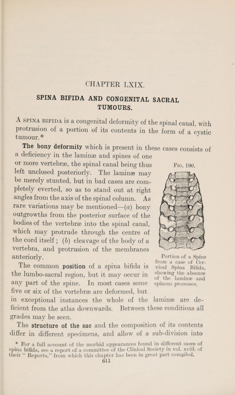 Pio. 190. SPINA BIFIDA AND CONGENITAL SACRAL TUMOURS. A SPINA bifida is a congenital deformity of the spinal canal, with protrusion of a portion of its contents in the form of a cystic tumour. * The bony deformity which is present in these cases consists of a deficiency in the laminae and spines of one or more vertebrae, the spinal canal being thus left unclosed posteriorly. The laminae may be merely stunted, but in bad cases are com¬ pletely everted, so as to stand out at right angles from the axis of the spinal column. As rare variations may be mentioned—(a) bony outgrowths from the posterior surface of the bodies of the vertebrae into the spinal canal, which may protrude through the centre of the cord itself ; (b) cleavage of the body of a vertebra, and protrusion of the membranes anteriorly. Portion of a Spine rrn ... r ~ n . from a case of Cer- ine common position of a spma bifida is vieal Spina Bifida, the lumbo-sacral region, but it may occur in showing tfie absence ° J ot the laminae and any part of the spine. In most cases some spinous processes, five or six of the vertebrae are deformed, but in exceptional instances the whole of the laminae are de¬ ficient from the atlas downwards. Between these conditions all grades may be seen. The structure of the sac and the composition of its contents differ in different specimens, and allow of a sub-division into * For a full account of the morbid appearances found in different cases of spina bifida, see a report of a committee of the Clinical Society in vol. xviii. of their Reports.” from which this chapter has been in great part compiled.