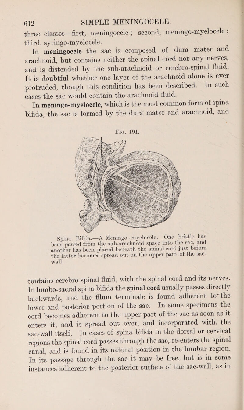 three classes—first, meningocele ; second, meningo-myelocele ; third, syringo-myelocele. In meningocele the sac is composed of dura mater and arachnoid, hut contains neither the spinal cord nor any nerves, and is distended by the sub-arachnoid or cerebro-spinal fluid. It is doubtful whether one layer of the arachnoid alone is ever protruded, though this condition has been described. In such cases the sac would contain the arachnoid fluid. In meningo-myelocele, which is the most common form of spina bifida, the sac is formed by the dura mater and arachnoid, and Fig. 191. Spina Bifida.—A Meningo - myelocele. One bristle has been passed from the sub-arachnoid space into the sac, and another has been placed beneath the spinal cord just before the latter becomes spread out on the upper part of the sac- wall. contains cerebro-spinal fluid, with the spinal cord and its nerves. In lumbo-sacral spina bifida the spinal cord usually passes directly backwards, and the filum terminale is found adherent to'the lower and posterior portion of the sac. In some specimens the cord becomes adherent to the upper part of the sac as soon as it enters it, and is spread out over, and incorporated with, the sac-wall itself. In cases of spina bifida in the dorsal or cervical regions the spinal cord passes through the sac, re-enters the spinal canal, and is found in its natural position in the lumbar region. In its passage through the sac it may be free, but is in some instances adherent to the posterior surface of the sac*wall, as in