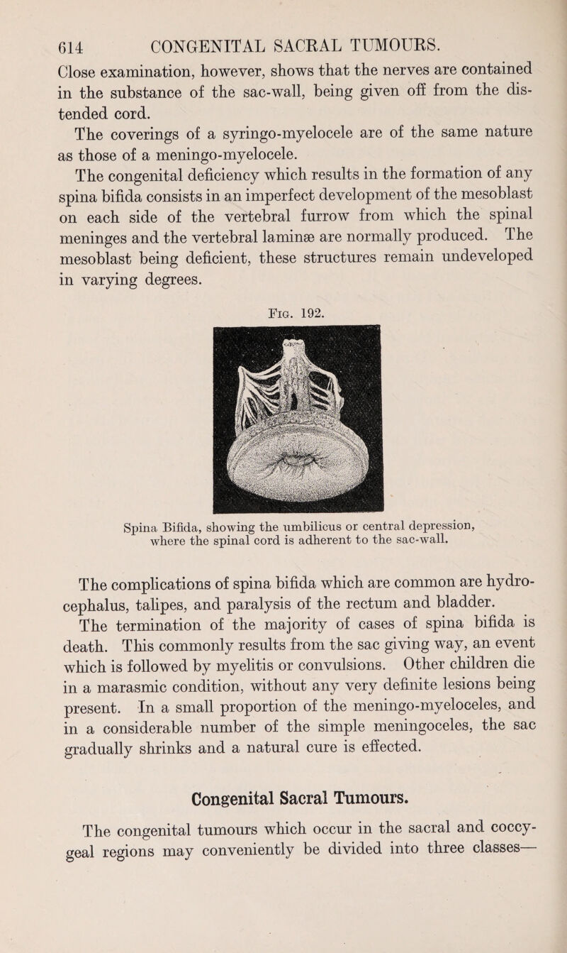 Close examination, however, shows that the nerves are contained in the substance of the sac-wall, being given off from the dis¬ tended cord. The coverings of a syringo-myelocele are of the same nature as those of a meningo-myelocele. The congenital deficiency which results in the formation of any spina bifida consists in an imperfect development of the mesoblast on each side of the vertebral furrow from which the spinal meninges and the vertebral laminae are normally produced. The mesoblast being deficient, these structures remain undeveloped in varying degrees. Fig. 192. Spina Bifida, showing the umbilicus or central depression, where the spinal cord is adherent to the sac-wall. The complications of spina bifida which are common are hydro¬ cephalus, talipes, and paralysis of the rectum and bladder. The termination of the majority of cases of spina bifida is death. This commonly results from the sac giving way, an event which is followed by myelitis or convulsions. Other children die in a marasmic condition, without any very definite lesions being present. In a small proportion of the meningo-myeloceles, and in a considerable number of the simple meningoceles, the sac gradually shrinks and a natural cure is effected. Congenital Sacral Tumours. The congenital tumours which occur in the sacral and coccy¬ geal regions may conveniently be divided into three classes—