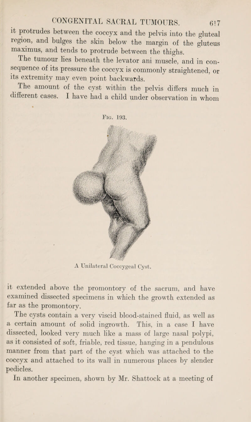 it protrudes between the coccyx and the pelvis into the gluteal region, and bulges the skin below the margin of the gluteus maximus, and tends to protrude between the thighs. The tumour lies beneath the levator ani muscle, and in con¬ sequence of its pressure the coccyx is commonly straightened, or its extremity may even point backwards. T he amount of the cyst within the pelvis differs much in different cases. I have had a child under observation in whom Fig. 193. A Unilateral Coccygeal Cyst. it extended above the promontory of the sacrum, and have examined dissected specimens in which the growth extended as far as the promontory. The cysts contain a very viscid blood-stained fluid, as well as a certain amount of solid ingrowth. This, in a case I have dissected, looked very much like a mass of large nasal polypi, as it consisted of soft, friable, red tissue, hanging in a pendulous manner from that part of the cyst which was attached to the coccyx and attached to its wall in numerous places by slender pedicles. In another specimen, shown by Mr. Shattock at a meeting of