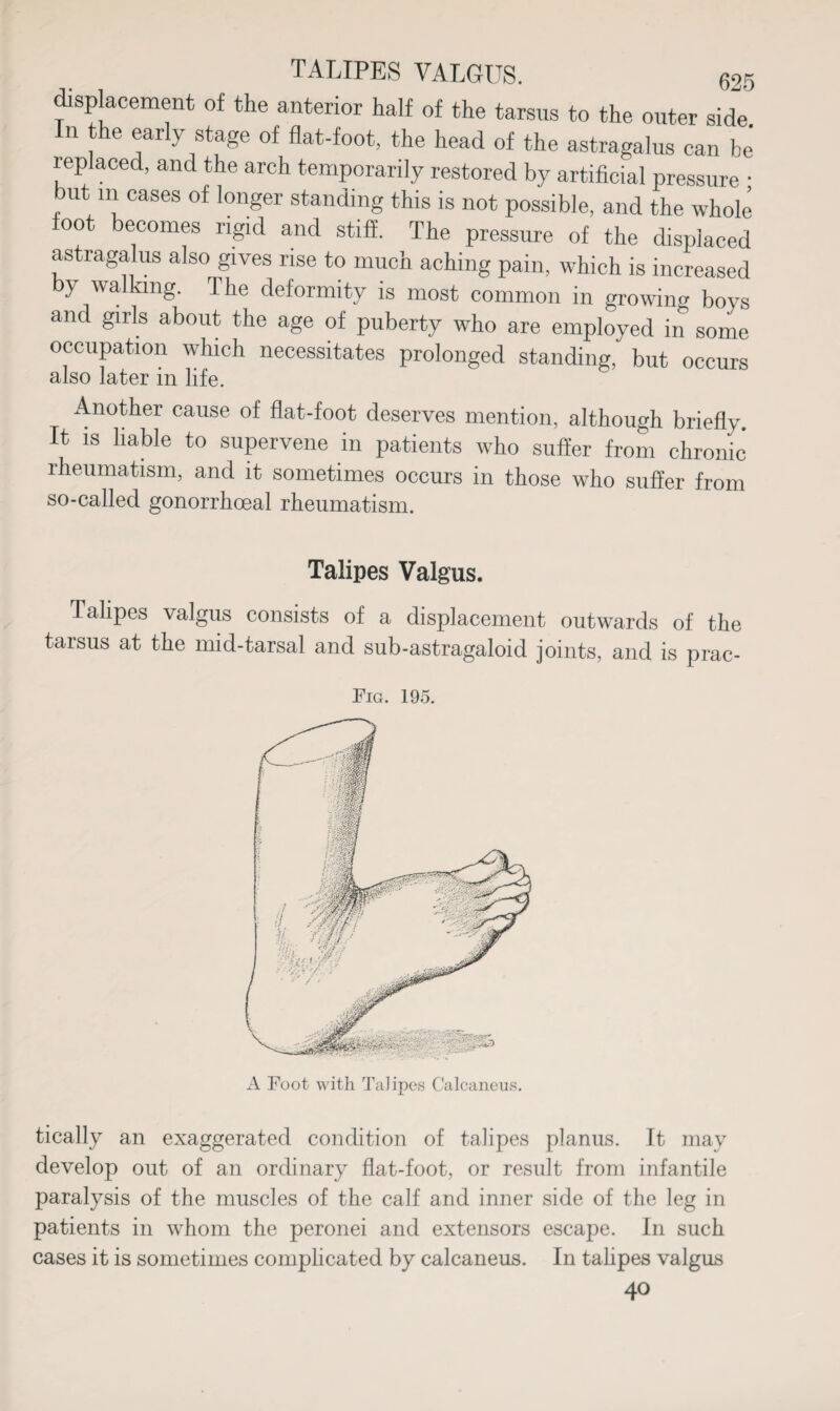 displacement of the anterior half of the tarsus to the outer side, n the early stage of flat-foot, the head of the astragalus can be replaced, and the arch temporarily restored by artificial pressure • but in cases of longer standing this is not possible, and the whole foot becomes rigid and stiff. The pressure of the displaced astragalus also gives rise to much aching pain, which is increased by walking. The deformity is most common in growing boys and girls about the age of puberty who are employed in some occupation which necessitates prolonged standing, but occurs also later in life. Another cause of flat-foot deserves mention, although briefly. It is liable to supervene in patients who suffer from chronic rheumatism, and it sometimes occurs in those who suffer from so-called gonorrhoeal rheumatism. Talipes Valgus. Talipes valgus consists of a displacement outwards of the tarsus at the mid-tarsal and sub-astragaloid joints, and is prac- Fig. 195. A Foot with Talipes Calcaneus. tically an exaggerated condition of talipes planus. It may develop out of an ordinary flat-foot, or result from infantile paralysis of the muscles of the calf and inner side of the leg in patients in whom the peronei and extensors escape. In such cases it is sometimes complicated by calcaneus. In talipes valgus 40