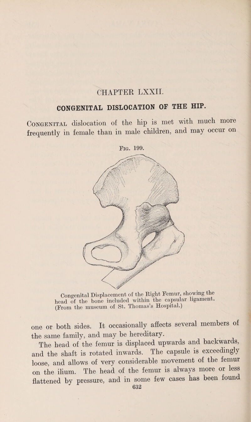 CONGENITAL DISLOCATION OF THE HIP. Congenital dislocation of the hip is met with much more frequently in female than in male children, and may occur on Fig. 199. Congenital Displacement of the Right Femur, showing the head of the bone included within the capsular ligament. (From the museum of St. Thomas’s Hospital.) one or both sides. It occasionally aflects several members of the same family, and may be hereditary. The head of the femur is displaced upwards and backwards, and the shaft is rotated inwards. The capsule is exceedingly loose, and allows of very considerable movement of the femur on the ilium. The head of the femur is always more or less flattened by pressure, and in some few cases has been found