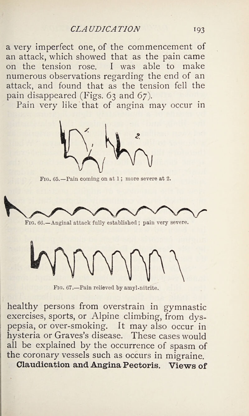 a very imperfect one, of the commencement of an attack, which showed that as the pain came on the tension rose. I was able to make numerous observations regarding the end of an attack, and found that as the tension fell the pain disappeared (Figs. 63 and 67). Pain very like that of angina may occur in Fig. 65.—Pain coming on at 1; more severe at 2. Fig. 66.—Anginal attack fully established ; pain very severe. healthy persons from overstrain in gymnastic exercises, sports, or Alpine climbing, from dys¬ pepsia, or over-smoking. It may also occur in hysteria or Graves's disease. These cases would all be explained by the occurrence of spasm of the coronary vessels such as occurs in migraine. Claudication and Angina Pectoris. Views of