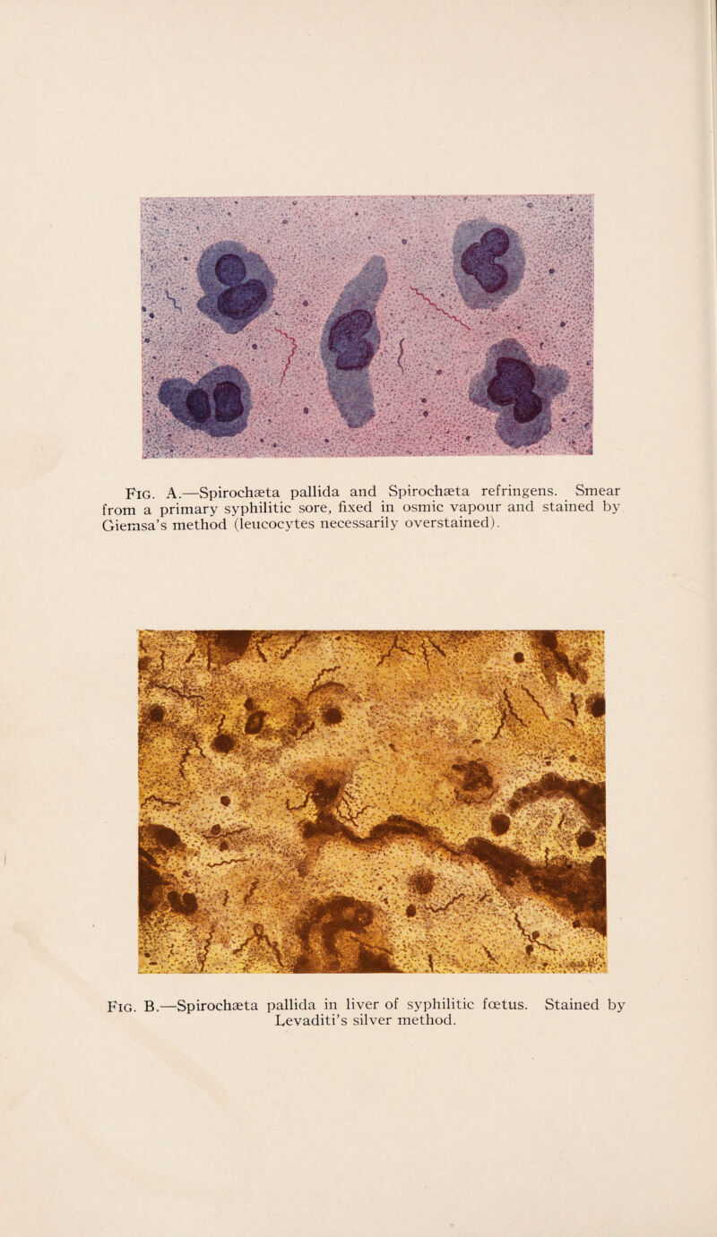 Fig. A.—Spirochaeta pallida and Spirochaeta refringens. Smear from a primary syphilitic sore, fixed in osmic vapour and stained by Giemsa’s method (leucocytes necessarily overstained). Fig. B.—Spirochaeta pallida in liver of syphilitic foetus. Stained by Fevaditi’s silver method.