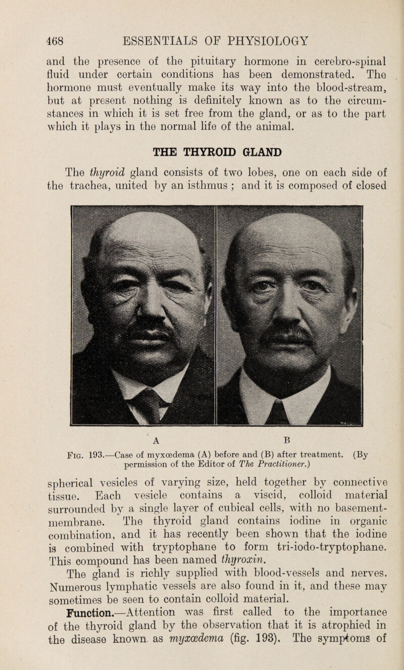 and the presence of the pituitary hormone in cerebro-spinal fluid under certain conditions has been demonstrated. The hormone must eventually make its way into the blood-stream, but at present nothing is definitely known as to the circum¬ stances in which it is set free from the gland, or as to the part which it plays in the normal life of the animal. THE THYROID GLAND The thyroid gland consists of two lobes, one on each side of the trachea, united by an isthmus ; and it is composed of closed A B Fig. 193.—Case of myxoedema (A) before and (B) after treatment. (By permission of the Editor of The Practitioner.) spherical vesicles of varying size, held together by connective tissue. Each vesicle contains a viscid, colloid material surrounded by a single layer of cubical cells, with no basement- membrane. The thyroid gland contains iodine in organic combination, and it has recently been shown that the iodine is combined with tryptophane to form tri-iodo-tryptophane. This compound has been named thyroxin. The gland is richly supplied with blood-vessels and nerves. Numerous lymphatic vessels are also found in it, and these may sometimes be seen to contain colloid material. Function.—Attention was first called to the importance of the thyroid gland by the observation that it is atrophied in the disease known as myxoedema (fig. 198). The symptoms of
