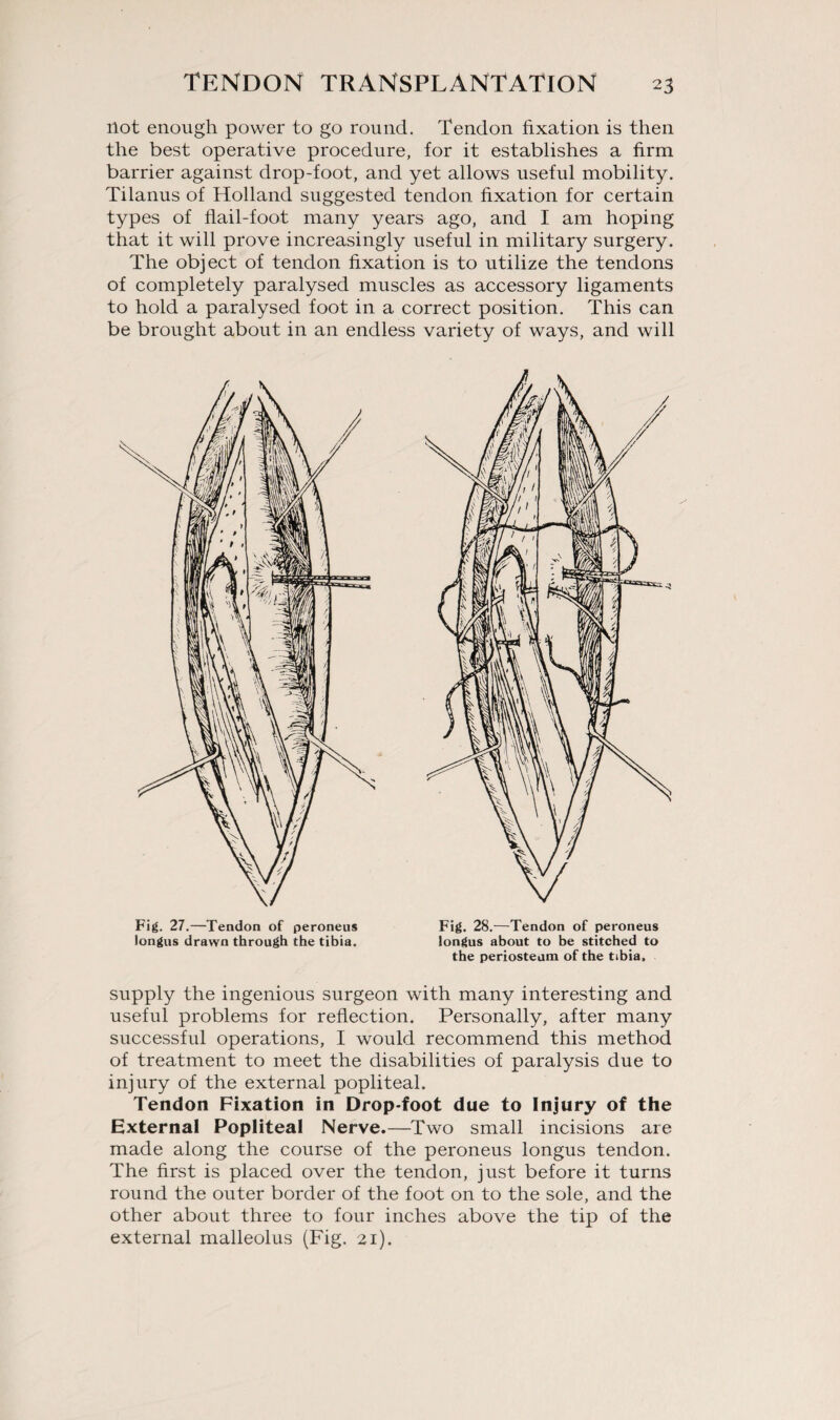 not enough power to go round. Tendon fixation is then the best operative procedure, for it establishes a firm barrier against drop-foot, and yet allows useful mobility. Tilanus of Holland suggested tendon fixation for certain types of flail-foot many years ago, and I am hoping that it will prove increasingly useful in military surgery. The object of tendon fixation is to utilize the tendons of completely paralysed muscles as accessory ligaments to hold a paralysed foot in a correct position. This can be brought about in an endless variety of ways, and will Fig. 27.—Tendon of peroneus longus drawn through the tibia. Fig. 28.—Tendon of peroneus longus about to be stitched to the periosteum of the tibia. supply the ingenious surgeon with many interesting and useful problems for reflection. Personally, after many successful operations, I would recommend this method of treatment to meet the disabilities of paralysis due to injury of the external popliteal. Tendon Fixation in Drop-foot due to Injury of the External Popliteal Nerve.—Two small incisions are made along the course of the peroneus longus tendon. The first is placed over the tendon, just before it turns round the outer border of the foot on to the sole, and the other about three to four inches above the tip of the external malleolus (Fig. 21).