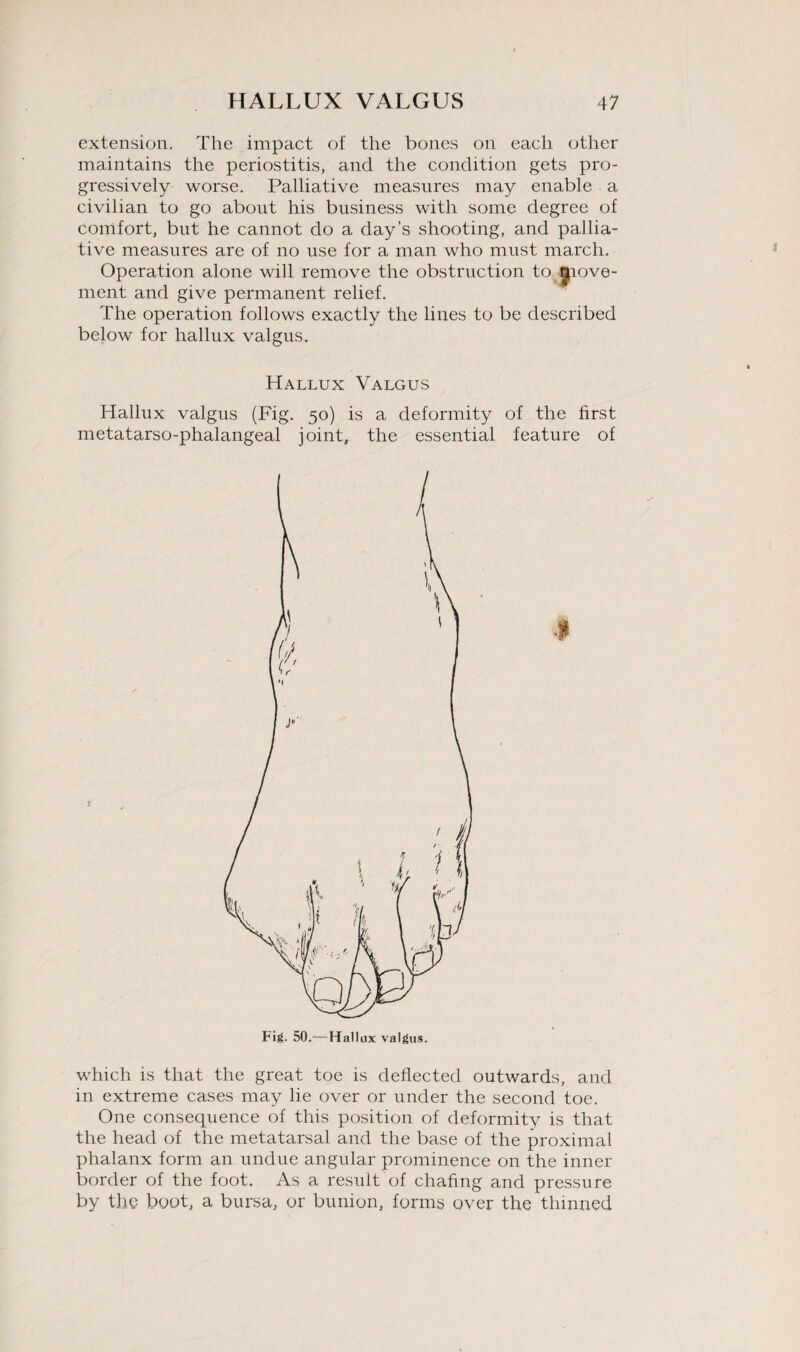 extension. The impact of the bones on each other maintains the periostitis, and the condition gets pro¬ gressively worse. Palliative measures may enable a civilian to go about his business with some degree of comfort, but he cannot do a day’s shooting, and pallia¬ tive measures are of no use for a man who must march. Operation alone will remove the obstruction to i|iove- ment and give permanent relief. The operation follows exactly the lines to be described below for hallux valgus. Hallux Valgus Hallux valgus (Fig. 50) is a deformity of the first metatarso-phalangeal joint, the essential feature of l Fig. 50.—Hallux valgus. which is that the great toe is deflected outwards, and in extreme cases may he over or under the second toe. One consequence of this position of deformity is that the head of the metatarsal and the base of the proximal phalanx form an undue angular prominence on the inner border of the foot. As a result of chafing and pressure by the boot, a bursa, or bunion, forms over the thinned