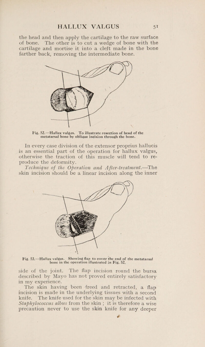 Fig. 53.—Hallux valgus. Showing hap to cover the end of the metatarsal bone in the operation illustrated in Fig. 52. side of the joint. The flap incision round the bursa described by Mayo has not proved entirely satisfactory in my experience. The skin having been freed and retracted, a flap incision is made in the underlying tissues with a second knife. The knife used for the skin may be infected with Staphylococcus albus from the skin ; it is therefore a wise precaution never to use the skin knife for any deeper HALLUX VALGUS 51 Fig. 52.—Hallux valgus. To illustrate resection of head of the metatarsal bone by oblique incision through the bone. In every case division of the extensor proprius hallucis is an essential part of the operation for hallux valgus, otherwise the traction of this muscle will tend to re¬ produce the deformity. Technique of the Operation and After-treatment.—The skin incision should be a linear incision along the inner the head and then apply the cartilage to the raw surface of bone. The other is to cut a wedge of bone with the cartilage and mortise it into a cleft made in the bone farther back, removing the intermediate bone. 4