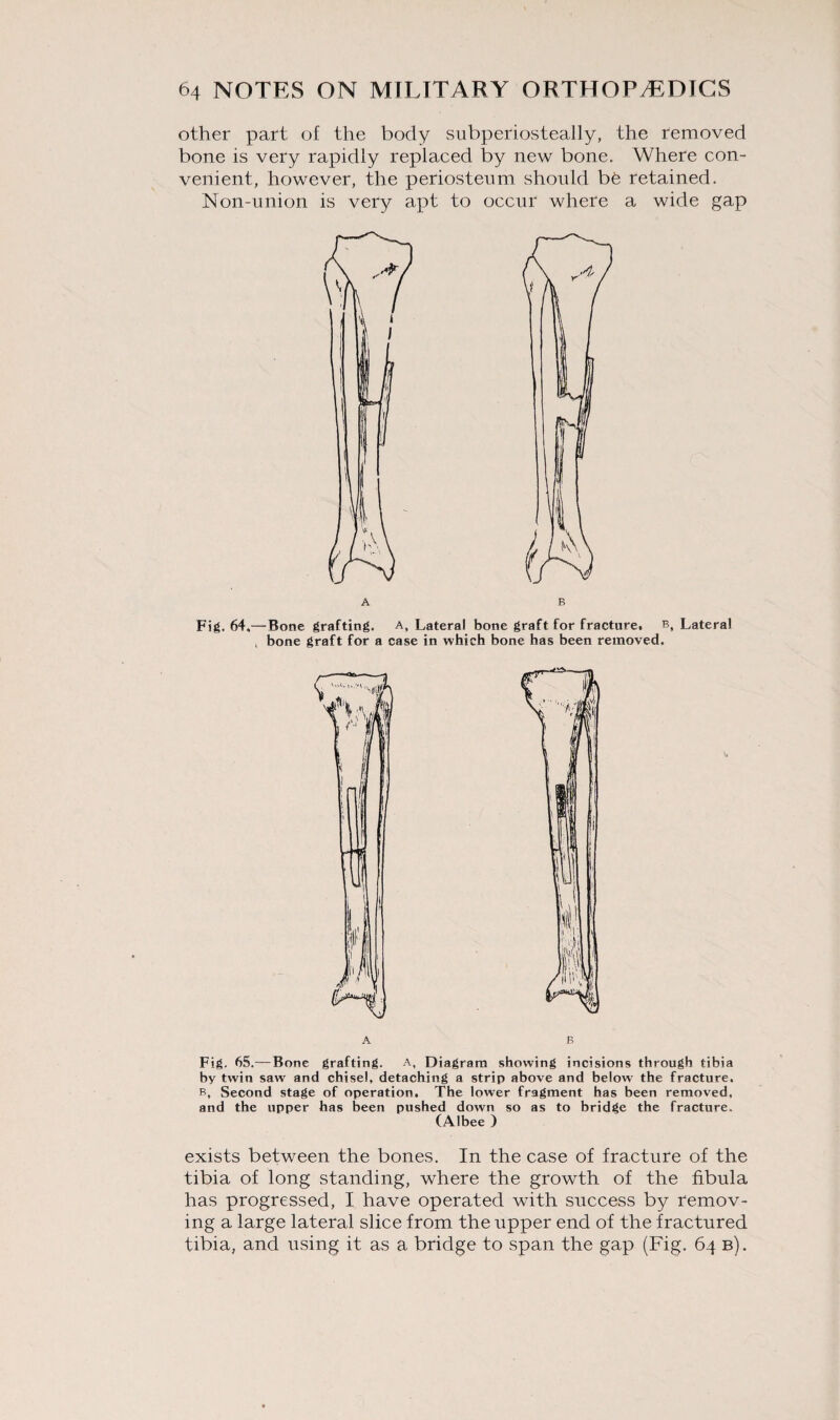 other part of the body subperiosteally, the removed bone is very rapidly replaced by new bone. Where con¬ venient, however, the periosteum should bt retained. Non-union is very apt to occur where a wide gap A B Fig. 64,—Bone grafting, a, Lateral bone graft for fracture, b, Lateral t bone graft for a case in which bone has been removed. A B Fig. 65.—Bone grafting, a, Diagram showing incisions through tibia by twin sawr and chisel, detaching a strip above and below the fracture. b, Second stage of operation. The lower fragment has been removed, and the upper has been pushed down so as to bridge the fracture. (Albee ) exists between the bones. In the case of fracture of the tibia of long standing, where the growth of the fibula has progressed, I have operated with success by remov¬ ing a large lateral slice from the upper end of the fractured tibia, and using it as a bridge to span the gap (Fig. 64 b).