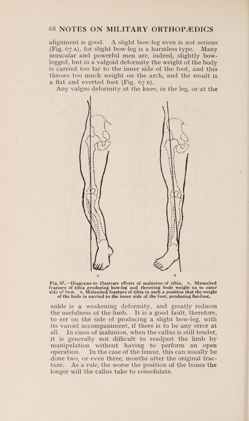 alignment is good. A slight bow-leg even is not serious (Fig. 67 a), for slight bow-leg is a harmless type. Many muscular and powerful men are, indeed, slightly bow- legged, but in a valgoid deformity the weight of the body is carried too far to the inner side of the foot, and this throws too much weight on the arch, and the result is a flat and everted foot (Fig. 67 b). Any valgus deformity at the knee, in the leg, or at the Fig. 67.—Diagrams to illustrate effects of maluuion of tibia. A, Malunited fracture of tibia producing bow-leg and throwing body weight on to outer side of foot. B, Malunited fracture of tibia in such a position that the weight of the body is carried to the inner side of the foot, producing flat-foot. ankle is a weakening deformity, and greatly reduces the usefulness of the limb. It is a good fault, therefore, to err on the side of producing a slight bow-leg, with its varoid accompaniment, if there is to be any error at all. In cases of malunion, when the callus is still tender, it is generally not difficult to readjust the limb by manipulation without having to perform an open operation. In the case of the femur, this can usually be done two, or even three, months after the original frac¬ ture. As a rule, the worse the position of the bones the longer will the callus take to consolidate.