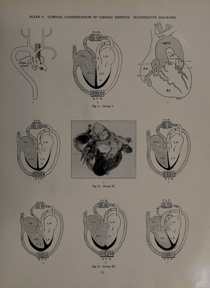 PLATE V. CLINICAL CLASSIFICATION OF CARDIAC DEFECTS. ILLUSTRATIVE DIAGRAMS Fig. 1.—Group I. i P.V.R. PV.R. P.V.R Fig. 3.—Group III.