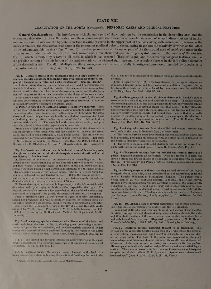 COARCTATION OF THE AORTA {Continued). PERSONAL CASES AND CLINICAL FEATURES General Considerations. The interference with the main part of the circulation by the constriction in the descending arch and the consequent dilatation of the collaterals above the obstruction give rise to a series of vascular signs and of x-ray findings that are of patho¬ gnomonic value. Such are the hypertension that invariably exists in the upper part of the body along with reduction of pressure in the lower extremities, the diminution or absence of the femoral or popliteal pulse to the palpating finger and the relatively slow rise of the latter in the sphygmographic tracing (Figs, la and b); the disappearance over the upper part of the thorax and neck of visible pulsations in the tortuous and dilated collaterals, which often transmit also a fine thrill and systolic or postsystolic murmur; the erosion of the ribs (see Fig. 3), which is visible by x-rays in all cases in which it has occurred (Roesler’s sign); and other roentgenological features, such as the peculiar contour of the left border of the cardiac shadow, the widened right base and the complete absence in the left oblique diameter of the descending arch (Fig. 6). Multiple capillary aneurysms seen in two carefully investigated cases were reported by Roesler as of diagnostic value {Wien. Arch. f. inn. Med., 1928, 15: 521). Fig. 1.—Complete atresia of the descending arch with large collateral cir¬ culation, saccular aneurysm of ascending arch with impending rupture, con¬ genitally bicuspid aortic valve and aortic insufficiency. Cerebral death.* a. Anterior view, showing the enormously dilated and hypertrophied left ventricle laid open to reveal its interior, the sclerosed and incompetent bicuspid aortic valve, the dilatation of the ascending aorta, and the displace¬ ment of the great trunks to the extreme left of the elongated transverse arch. a, the narrow aortic isthmus giving off an anomalous vessel; b, the area of complete obliteration at the level of c, the ligamentum arteriosum; d, interior of pulmonary artery; e, enlarged periarterial gland. b. Posterior view of aortic arch and interior of dissective aneurysm. Just beyond the great trunks the aortic isthmus narrows rapidly to a ring of further constriction which coincides internally with a complete obliteration, the aorta above and below this point ending blindly in a shallow biconcave disc lined with shining healthy intima, indicating arrest of the fourth left arch at its junction with the sixth. The aorta below this area widens rapidly and pre¬ sents the dilated orifices of the upper aortic intercostals. From a boy of high intelligence, aged 14, who presented the characteristic clinical picture of coarctation with huge development of the collateral circu¬ lation, and died in coma setting in 12 hours before death. The brain was not examined, but cerebral haemorrhage was undoubtedly the cause. (Reported by W. F. Hamilton and M. E. Abbott, Amer. Heart J., 1928, 3: 381; 574. Drawings by H. Blackstock, Medical Art Department, McGill University.) Fig. 2.-—Coarctation of the aorta with double stricture of descending arch, bicuspid aortic valve, aortic, mitral and tricuspid stenosis and aortic and mitral insufficiency.* Sudden death. A. Inner and outer views of the transverse and descending arch. Just beyond the left subclavian it has become abruptly narrowed (upper stricture) and then widens to undergo again at the level of the obliterated ductus a second very sharp kinking which corresponds internally to a thickened intimal ridge or shelf, enclosing a very narrow lumen. The aorta between these two points is ballooned out and twisted on itself. Below the second stricture it widens rapidly and attains after receiving the collateral supply through the dilated aortic intercostals a circumference of 56 mm. B. Heart showing a marked simple hypertrophy of the left ventricle with dilatation and hypertrophy of both auricles, especially the right. The bicuspid aortic valve presents a low raphe behind the combined coronary seg¬ ments and both segments are greatly thickened and manifestly incompetent. From a primipara aged 34, who presented signs of cardiac insufficiency during her pregnancy and was successfully delivered by cesarian section in the eighth month of a viable baby, but died quietly in her sleep six nights later. (Report from the Pathological Service of the Royal Victoria Hospital, kindly supplied by W. H. Chase. Published by M. E. Abbott, Libman Ann. Vol., 1932, 1: 1. Drawing by H. Blackstock, Medical Art Department, McGill University.) Fig. 3.—Roentgenograph in antero-posterior diameter of the heart and aortic arch from the case in Fig. 1, showing great broadening and con¬ vexity to right of the aortic shadow, and the characteristic contour of the left border with absence of aortic knob and kinking in the region of the aortic ist hmus, also erosion of the ribs. (From Amer. Heart J., 1928, 3 : 385, Fig. 1.) Fig. 4.—The dilated and tortuous internal mammary arteries as they pass down to anastomose with the deep epigastrium in the upkeep of the collateral circulation. {Ibid., p. 389, Fig. 4.) Fig. 5.—Vascular signs. Markings in heavy charcoal on the back of a living case of coarctation, indicating the position of forcible pulsations in the dilated and tortuous branches of the dorsalis scapulae, supra- and subscapular arteries. From a carpenter aged 58, with hypertension in the upper extremities, diminished femoral pulse and large collateral circulation, diagnosed during life from these features. (Republished by permission from the article by J. T. King, Arch. Int. Med., 1926, 38: 99.) Fig. 6.—-Roentgenograph in the left oblique diameter in Roesler’s case of coarctation in a man of 45, who died suddenly in his sleep. The picture shows the ascending aorta dilated and passing backward toward the vertebral column at what appears to be a somewhat higher level than usual. In the retroaortic and retrocardiac space below it, the bifurcation of the trachea and one bron¬ chus are clearly visible anteriorly, but behind these the area that is normally crossed by the descending arch is occupied by a clear space, the shadow of the descending arch being absent in this situation. (From H. Roesler, Wien. Arch. f. inn. Med., 1928, 16: 520, Fig. 3.) Fig. 7.—Polygraphic tracings from the radial and femoral arteries and collaterals of the back, in Roesler’s Case 2 of coarctation. a. The femoral curve is much lower than in the radial and arises slowly and falls gradually, producing an elevation with an obtuse flattened top, and the rise begins a little later than that of the radial. b. The curve in the collaterals is still shallower but the rise begins synchron¬ ously with that in the radial pulse. (From H. Roesler, ibid., Fig. 5.) Fig. 8.—-Polygraphic tracings from the brachial and femoral arteries in a patient diagnosed clinically as coarctation. Note the difference in form, the slow up-stroke and low amplitude of the femoral as compared with the radial tracing. (From Laubry and Pezzi, Traite des maladies congenitales du coeur, 1921, p. 263, Fig. 94.) Fig. 9.—Roentgenogram of thorax, showing marked erosion of the fourth to eighth ribs on both sides, in an unpublished case of coarctation, under the care of Douglas Wilkinson of Birmingham, England. The patient was a young man of 21, well built and powerful, a football and cricket player. Routine physical examination revealed a systolic pressure of 280 degrees with a diastolic so low that it could not be made out satisfactorily and no pulse palpable in the iliacs or abdominal aorta. Heart action was forcible but the organ was hardly enlarged. The diagnosis was made on the above character¬ istic findings. (From the copy kindly supplied by Dr. Wilkinson for this Atlas.) Fig. 10.—Dr. Libman’s case of mycotic aneurysm of the thoracic aorta just below the seat of coarctation with rupture into the left bronchus. From a girl of 12, who died with symptoms of bacteraemia of one month’s duration. Autopsy showed abundant streptococcus haemolyticus in the walls and thrombotic contents of the aneurysm, with subacute glomerulonephritis and embolism of femoral artery. (Reported by permission by M. E. Abbott, Blumer’s Bedside Diag., 1928, 3 : 376, Fig. 258. Drawing by A. Feinberg.) Fig. 11.—Ruptured cerebral aneurysm thought to be congenital. This patient was an apparently healthy young man of 24, who fell on the street in an epileptiform convulsion and was brought into hospital in coma and died a few hours later. The base of the brain was enveloped in abundant haemorrhage, and dissection showed this small thin-walled sac at the second bifurcation of the anterior cerebral artery torn across on its free surface. Microscopic examination showed intimal proliferation and some medial degen¬ eration. There was no coarctation but the case illustrates a not infrequent complication of this. (From C. P. Symonds, “Spontaneous subarachnoid haemorrhage,” Quart. J. Med., 1924-25, 18: 118, Case 2.) * Specimen in the Cardiac Anomaly Collection of McGill University.