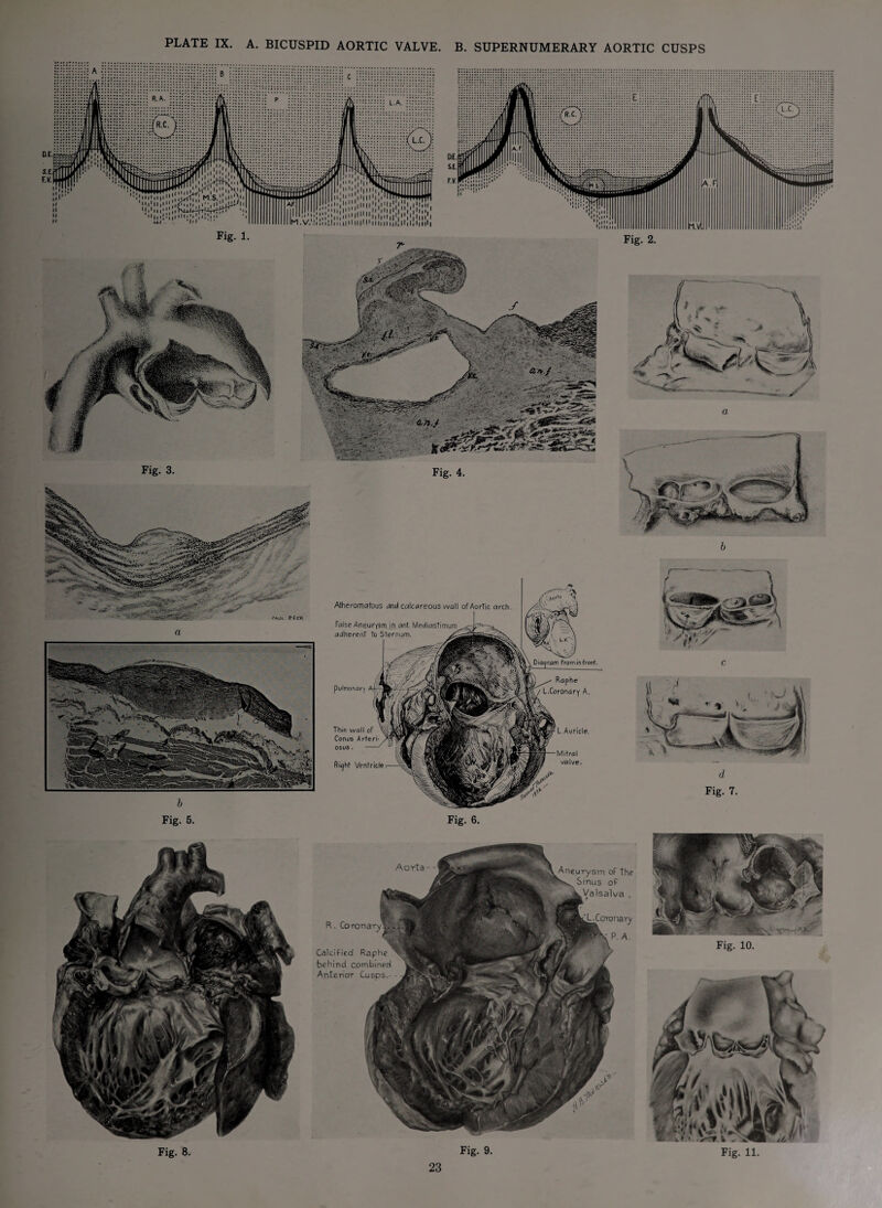 PLATE IX. A. BICUSPID AORTIC VALVE. B. SUPERNUMERARY AORTIC CUSPS Atheromatous and calcareous wall of Aortic arch. False Aneurysm in ant. Mediastimum adherent To Sternum. pulmonary Thin wall of Conus Arteri os us. fti^ht Ventricle Fig. 1. Raphe L.Coronary A. L. Auricle. Mitral valve. Fig. 3. Fig. 2. d Fig. 7. Fig. 5. Fig. 6. Aneurysm of the Sinus of Valsalva . Aorta Calcified Raphe behind combined Anterior Cusps. Fig. 8. Fig. 9. Fig. 11.