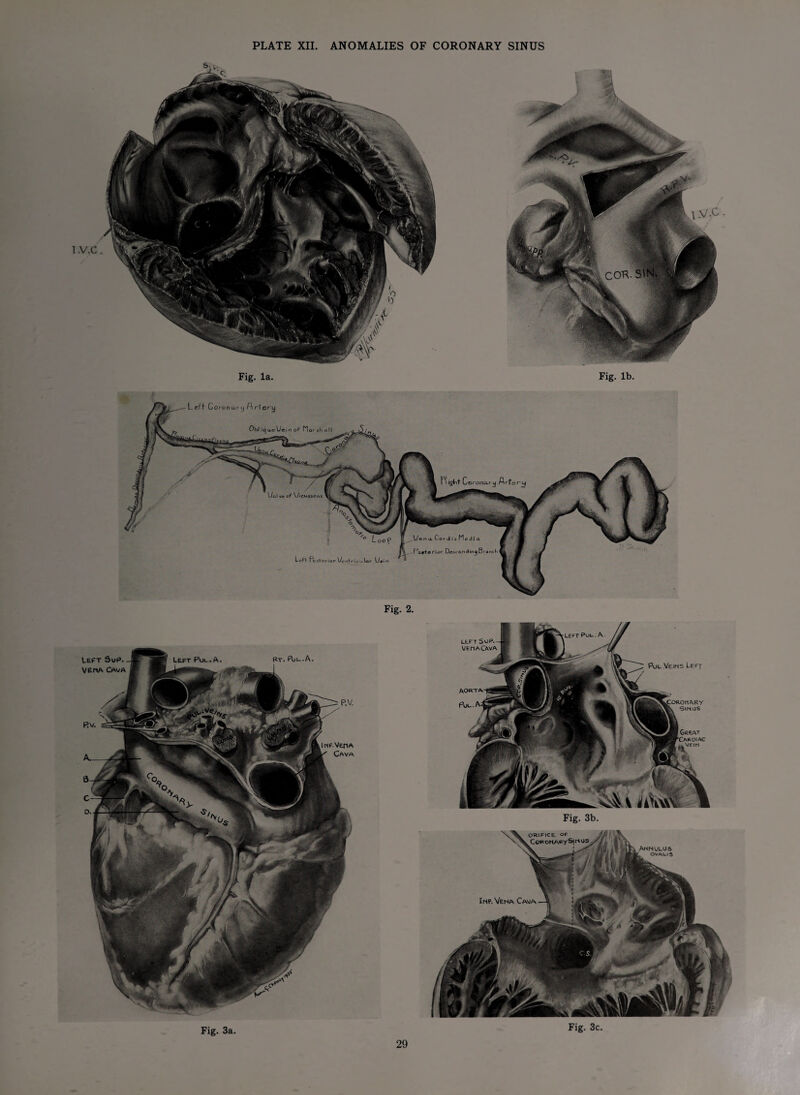 PLATE XII. ANOMALIES OF CORONARY SINUS I .v.c. Fig. la. Fig. lb. Fig. 2. Fig. 3c. Fig. 3a.