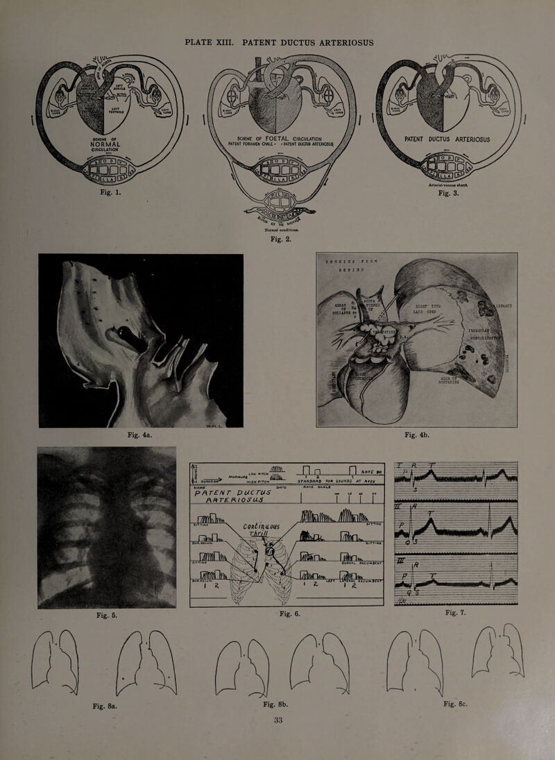 PLATE XIII. PATENT DUCTUS ARTERIOSUS 1 1 SCHEME OF FOETAL CIRCULATION PATENT FORAMEN OVALE - - PATENT DUCTUS ARTERIOSUS. Normal conditions. Fig. 2. I Arterial-venous shunt. Fig. 3. I Fig. 4a. .AORTA IfcTURNED % UP AREAS ' OF COLLAPSE W RIGHT' LUTIG LAID OPEll IRRKGUTA5 v' ■ vfcjS CONSOLIDATE ’AT I Oil i AREA OF**- SOFTEllIHG Fig. 4b. Fig. 8a. Jljc ' ... Fig. 7. Fig. 8b. Fig. 8c.
