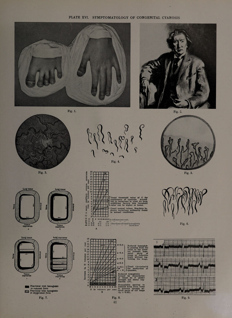 PLATE XVI. SYMPTOMATOLOGY OF CONGENITAL CYANOSIS Fig. 3. tissue Tissue Capillaries a tissue Tissue Capillaries b > 5 Jo Usual threshold value of C for appearance of cyanosis. Accord¬ ing to variations in what we term modifying factors this threshold i can be higher or lower. 1 normal values. Brackets In¬ dicate variations ordinarily found in normal conditions. T o D = 0 > = 0.0 — 0.0 5 io is 20 *530 jn volumes per cent. 10 20 ' 0.5 0.5 1.0 “ fractions of total hemoglobin 1.0 blood flow Fig. 5. Lung tissue Lung capillaries EU Fractional total hemoglobin In reduced form Fractional total hemoglobin in oxygenated form 0123456789 10 D In volumes per cent. B Reduced hemoglob¬ in passing from the veins to the arter¬ ies through unae¬ rated parts of lungs or defective heart without tra¬ versing the lungs. Usual threshold for production of cyanosis. Reduced hemoglobin formed by deoxydatlon of blood as it passes through the tissue cap¬ illaries (D). Hemoglobin passing In reduced form from veins to arteries through ae¬ rated parts of the lungs (h = 0.05).