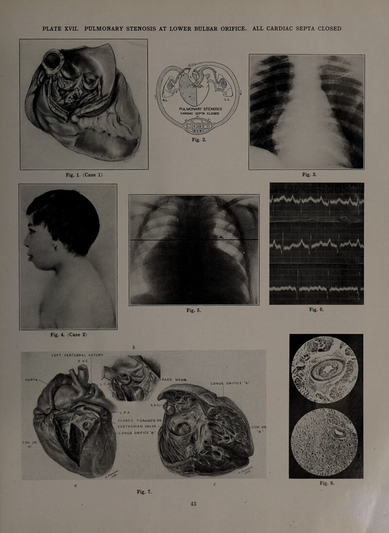 PLATE XVII. PULMONARY STENOSIS AT LOWER BULBAR ORIFICE. ALL CARDIAC SEPTA CLOSED Fig. 1. (Case 1) Fig. 3. Fig. 5. Fig. 6. Fig. 4. (Case 2) b Fig. 7. Fig. 8. LEFT VERTEBRAL ARTERY- S. V. C. J AORTA CONUS ORIFICE A. .CON. OR “ B. PARS. MEMB. OV CLOSED FORAMEN EUSTACHIAN VALVE CONUS ORIFICE‘'B. CON. OR. ■a: