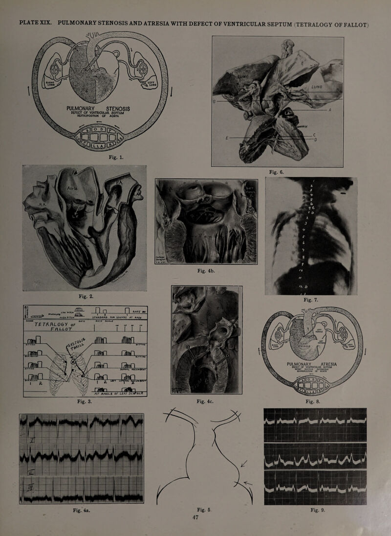 PLATE XIX. PULMONARY STENOSIS AND ATRESIA WITH DEFECT OF VENTRICULAR SEPTUM (TETRALOGY OF FALLOT) Fig. 1. Fig. 2. Fig. 6.