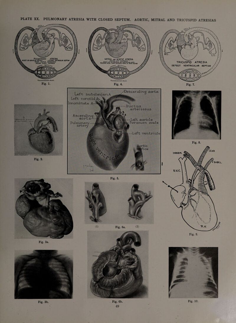 PLATE XX. PULMONARY ATRESIA WITH CLOSED SEPTUM. AORTIC, MITRAL AND TRICUSPID ATRESIAS Fig. 1. Fig. 4. Fig. 2. ? fUtt 34f- Left su/bcla Left coroti Innominate A Ascendinqr aorta- Pulmonary- artery ^'Descending aorta Ductus arter io3cis -Left auricle For ame n oval e Left ventricle