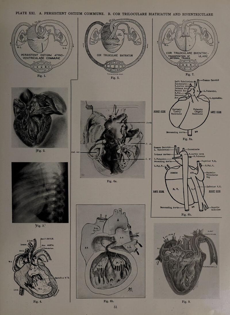 PLATE XXI. A. PERSISTENT OSTIUM COMMUNE. B. COR TRILOCULARE BIATRIATUM AND BIVENTRICULARE Fig. 1. (Fig. 2. V S. Venous-arterial shunt. Fig. 7. Fig. 5. Fig. 6a. rud. car Aorta P. A L. V. Left Subclavian- Innominate— | H.Aortic Arch Isthmus Kor.A- Patent Duc.f- H.Pul__ Descending Apr. Coonon Carotid A.w—L. Pulmonic'. RIOHT SIDE L. Appendix. LEFT SIDE Descending Aorta— Fig. 8a. Common Carotid- L. Subclavian- Isthmus Aortae-—J-- L.PulmoniC' Ascending Aorta— L.Pul.V.-- —Innominate R.Aortic Arch —n—R.Pulmonic Superior V.C. --R.Pul.V. —Omphalo- Mesenterio Bay 1—Inferior V.C, RIGHT SIDE Descending Aorta —Hepatic Radicles Fig. 8b. Fig. 4. Fig. 6b. Fig. 9.