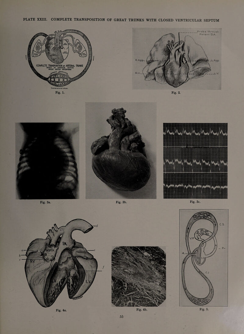 Fig. 1. _Probe throuqh Patent D.A. L-App- Fig. 2. Fig. 3b. Fig. 3c. Fig. 4a. Fig. 4b.