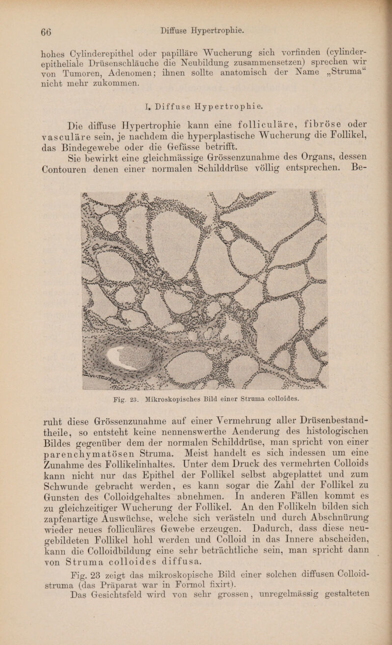 hohes Cylinderepithel oder papilläre Wucherung sich vorfinden (cylinder- epitheliale Drüsenschläuche die Neubildung zusammensetzen) sprechen wir von Tumoren, Adenomen; ihnen sollte anatomisch der Name „Struma“ nicht mehr zukommen. I» Diffuse Hypertrophie. Die diffuse Hypertrophie kann eine folliculäre, fibröse oder vasculäre sein, je nachdem die hyperplastische Wucherung die Follikel, das Bindegewebe oder die Befasse betrifft. Sie bewirkt eine gleichmässige Grössenzunahme des Organs, dessen Contouren denen einer normalen Schilddrüse völlig entsprechen. Be- Fig. 23. Mikroskopisches Bild einer Struma colloides. ruht diese Grössenzunahme auf einer Vermehrung aller Drüsenbestand- theile, so entsteht keine nennenswerthe Aenderung des histologischen Bildes gegenüber dem der normalen Schilddrüse, man spricht von einer parenchymatösen Struma. Meist handelt es sich indessen um eine Zunahme des Follikelinhaltes. Unter dem Druck des vermehrten Colloids kann nicht nur clas Epithel der Follikel selbst abgeplattet und zum Schwunde gebracht werden, es kann sogar die Zahl der Follikel zu Gunsten des Colloidgehaltes abnehmen. In anderen Fällen kommt es zu gleichzeitiger Wucherung der Follikel. An den Follikeln bilden sich zapfenartige Auswüchse, welche sich verästeln und durch Abschnürung wieder neues folliculäres Gewebe erzeugen. Dadurch, dass diese neu¬ gebildeten Follikel hohl werden und Colloid in das Innere abscheiden, kann die Colloidbildung eine sehr beträchtliche sein, man spricht dann von Struma colloides diffusa. Fig. 23 zeigt das mikroskopische Bild einer solchen diffusen Colloid- struma (das Präparat war in Formol fixirt). Das Gesichtsfeld wird von sehr grossen, unregelmässig gestalteten