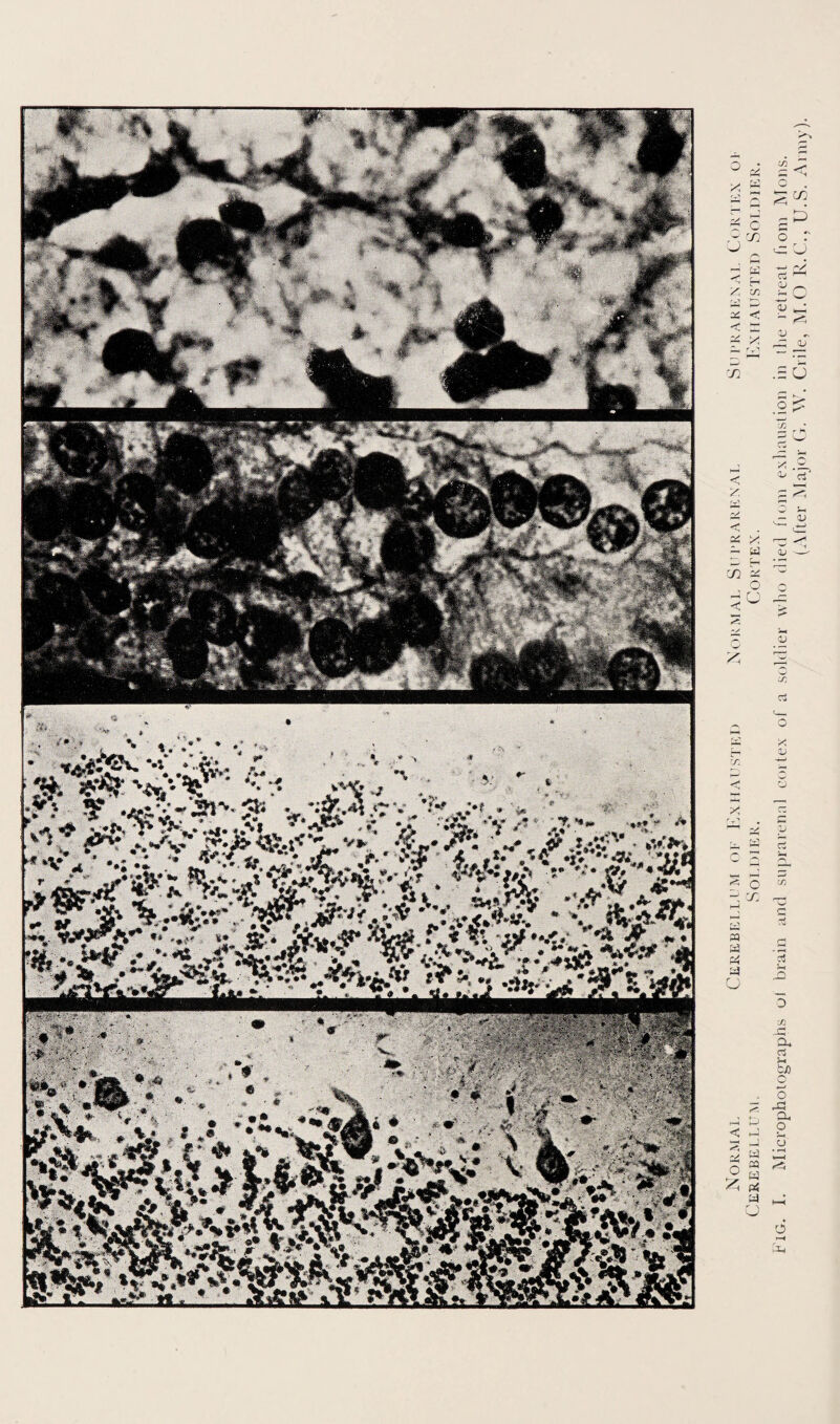 Normal Cerebellum of Exhausted Normal Suprarenal Suprarenal Cortex op Cerebellum. Soldier. Cortex. Exhausted Soldier. pig. I. Microphoiographs ol brain and suprarenal cortex of a soldier who died fiom exhaustion in the retreat fiom Mods. (After Major G. W. Chile, M.O R.C., U.S. Army).
