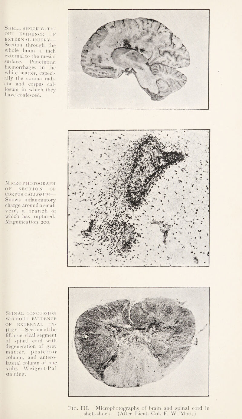 .'Shell shock with¬ out EVIDENCE OF EXTERNAL INJURY — Section through the whole brain i inch external to the mesial surface. Punctiform haemorrhages in the white matter, especi¬ ally the corona radi- ata and corpus cal¬ losum in which they have coalesced. Micro p holograph OF SECTION OF CORPUS CALLOSUM — Shows inflammatory charge around a small vein, a branch of which has ruptured. Magnification 200. Spinal concussion WITHOUT EVIDENCE OF EXTERNAL IN¬ JURY.—Section of the fifth cervical segment of spinal cord with degeneration of grey matter, posterior column, and antero¬ lateral column of one side. Weigerl-Pal staining. Fig. III. Microphotographs of brain and spinal cord in shell-shock. (After Lieut.-Col. F. W. Mott.)