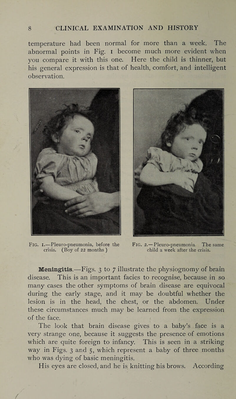 temperature had been normal for more than a week. The abnormal points in Fig. I become much more evident when you compare it with this one. Here the child is thinner, but his general expression is that of health, comfort, and intelligent observation. Fig. I.—Pleuro-pneumonia, before the crisis. (Boy of 22 months ) FlG. 2.— Pleuro-pneumonia. The same child a week after the crisis. Meningitis.—Figs. 3 to 7 illustrate the physiognomy of brain disease. This is an important facies to recognise, because in so many cases the other symptoms of brain disease are equivocal during the early stage, and it may be doubtful whether the lesion is in the head, the chest, or the abdomen. Under these circumstances much may be learned from the expression of the face. The look that brain disease gives to a baby’s face is a very strange one, because it suggests the presence of emotions which are quite foreign to infancy. This is seen in a striking way in Figs. 3 and 5, which represent a baby of three months who was dying of basic meningitis. H is eyes are closed, and he is knitting his brows. According