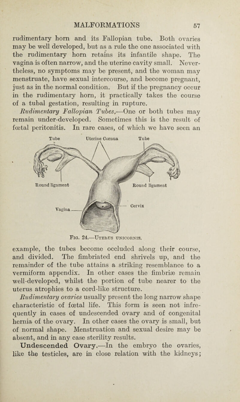 rudimentary horn and its Fallopian tube. Both ovaries may be well developed, but as a rule the one associated with the rudimentary horn retains its infantile shape. The vagina is often narrow, and the uterine cavity small. Never¬ theless, no symptoms may be present, and the woman may menstruate, have sexual intercourse, and become pregnant, just as in the normal condition. But if the pregnancy occur in the rudimentary horn, it practically takes the course of a tubal gestation, resulting in rupture. Rudimentary Fallopian Tubes.—One or both tubes may remain under-developed. Sometimes this is the result of foetal peritonitis. In rare cases, of which we have seen an Tube Uterine Cornua Tube example, the tubes become occluded along their course, and divided. The fimbriated end shrivels up, and the remainder of the tube attains a striking resemblance to a vermiform appendix. In other cases the fimbriae remain well-developed, whilst the portion of tube nearer to the uterus atrophies to a cord-like structure. Rudimentary ovaries usually present the long narrow shape characteristic of foetal life. This form is seen not infre¬ quently in cases of undescended ovary and of congenital hernia of the ovary. In other cases the ovary is small, but of normal shape. Menstruation and sexual desire may be absent, and in any case sterility results. Undescended Ovary.—In the embryo the ovaries, like the testicles, are in close relation with the kidneys;
