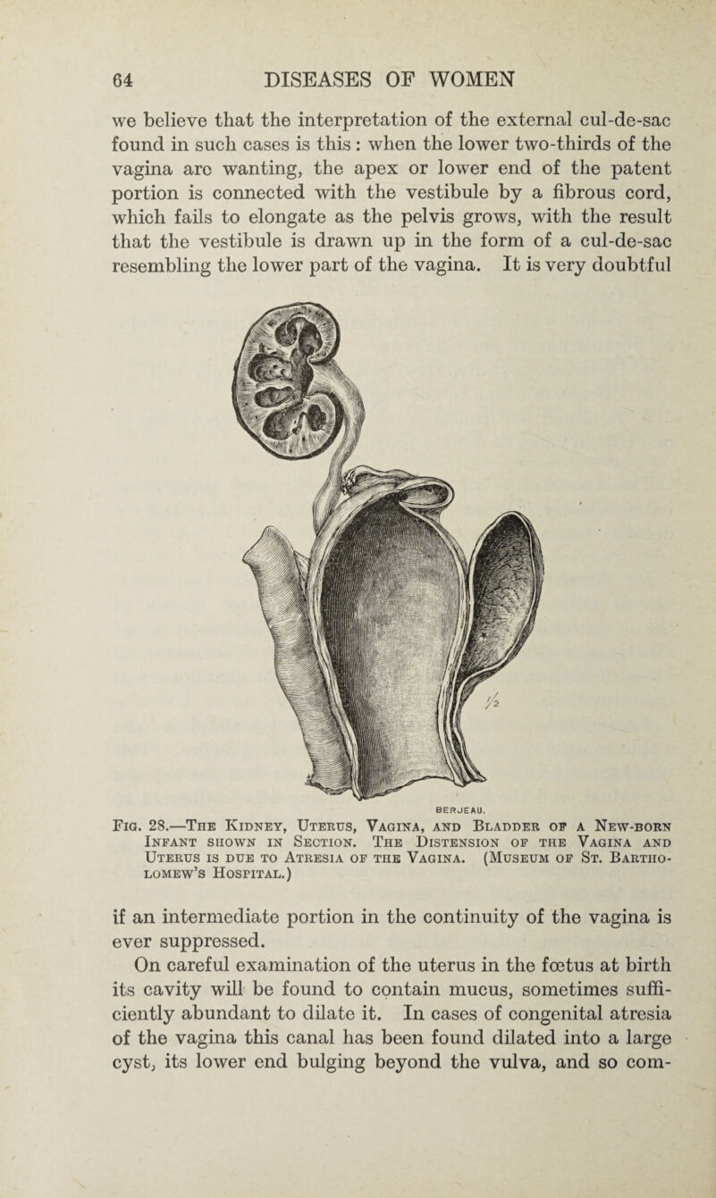 we believe that the interpretation of the external cul-de-sac found in such cases is this : when the lower two-thirds of the vagina are wanting, the apex or lower end of the patent portion is connected with the vestibule by a fibrous cord, which fails to elongate as the pelvis grows, with the result that the vestibule is drawn up in the form of a cul-de-sac resembling the lower part of the vagina. It is very doubtful BERJEAU. Fig. 28.—The Kidney, Uterus, Vagina, and Bladder of a New-born Infant shown in Section. The Distension of the Vagina and Uterus is due to Atresia of the Vagina. (Museum of St. Bartho¬ lomew’s Hospital.) if an intermediate portion in the continuity of the vagina is ever suppressed. On careful examination of the uterus in the foetus at birth its cavity will be found to contain mucus, sometimes suffi¬ ciently abundant to dilate it. In cases of congenital atresia of the vagina this canal has been found dilated into a large cyst, its lower end bulging beyond the vulva, and so com-