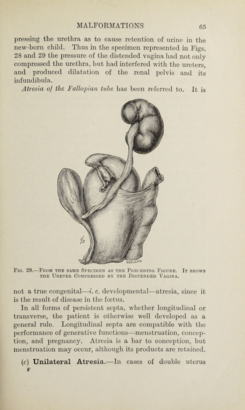 pressing the urethra as to cause retention of urine in the new-born child. Thus in the specimen represented in Figs. 28 and 29 the pressure of the distended vagina had not only compressed the urethra, but had interfered with the ureters, and produced dilatation of the renal pelvis and its infundibula. Atresia of the Fallopian tube has been referred to. It is Fig. 29.—From the same Specimen as the Preceding Figure. It shows the Ureter Compressed by the Distended Vagina. not a true congenital—i. e. developmental—atresia, since it is the result of disease in the foetus. In all forms of persistent septa, whether longitudinal or transverse, the patient is otherwise well developed as a general rule. Longitudinal septa are compatible with the performance of generative functions—menstruation, concep¬ tion, and pregnancy. Atresia is a bar to conception, but menstruation may occur, although its products are retained. (c) Unilateral Atresia.—In cases of double uterus F
