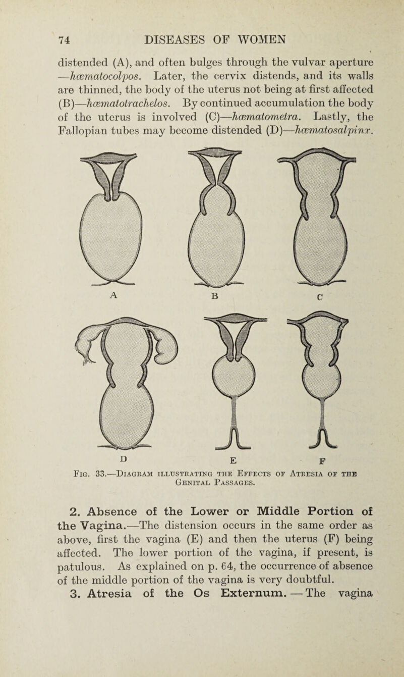 distended (A), and often bulges through the vulvar aperture —hcematocol'pos. Later, the cervix distends, and its walls are thinned, the body of the uterus not being at first affected (B)—hcematotrachelos. By continued accumulation the body of the uterus is involved (C)—hcematometra. Lastly, the Fallopian tubes may become distended (D)—hcematosalpinr. Fig. 33.—Diagram illustrating the Effects of Atresia of the Genital Passages. 2. Absence of the Lower or Middle Portion of the Vagina.—The distension occurs in the same order as above, first the vagina (E) and then the uterus (F) being affected. The lower portion of the vagina, if present, is patulous. As explained on p. 64, the occurrence of absence of the middle portion of the vagina is very doubtful. 3. Atresia of the Os Externum. — The vagina