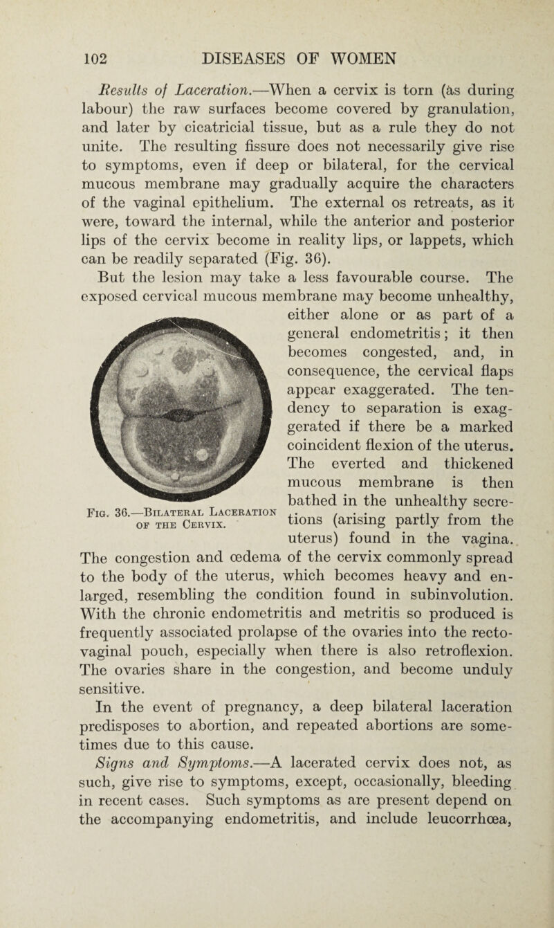 Results of Laceration.—When a cervix is torn (as during labour) the raw surfaces become covered by granulation, and later by cicatricial tissue, but as a rule they do not unite. The resulting fissure does not necessarily give rise to symptoms, even if deep or bilateral, for the cervical mucous membrane may gradually acquire the characters of the vaginal epithelium. The external os retreats, as it were, toward the internal, while the anterior and posterior lips of the cervix become in reality lips, or lappets, which can be readily separated (Fig. 36). But the lesion may take a less favourable course. The exposed cervical mucous membrane may become unhealthy, either alone or as part of a general endometritis; it then becomes congested, and, in consequence, the cervical flaps appear exaggerated. The ten¬ dency to separation is exag¬ gerated if there be a marked coincident flexion of the uterus. The everted and thickened mucous membrane is then bathed in the unhealthy secre¬ tions (arising partly from the uterus) found in the vagina. The congestion and oedema of the cervix commonly spread to the body of the uterus, which becomes heavy and en¬ larged, resembling the condition found in subinvolution. With the chronic endometritis and metritis so produced is frequently associated prolapse of the ovaries into the recto¬ vaginal pouch, especially when there is also retroflexion. The ovaries share in the congestion, and become unduly sensitive. In the event of pregnancy, a deep bilateral laceration predisposes to abortion, and repeated abortions are some¬ times due to this cause. Signs and Symptoms.—A lacerated cervix does not, as such, give rise to symptoms, except, occasionally, bleeding in recent cases. Such symptoms as are present depend on the accompanying endometritis, and include leucorrhcea, Fig. 36.—Bilateral Laceration of the Cervix.