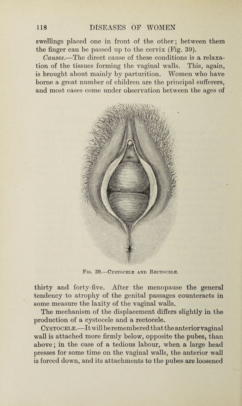 swellings placed one in front of the other; between them the finger can be passed op to the cervix (Fig. 39). Causes.—The direct cause of these conditions is a relaxa¬ tion of the tissues forming the vaginal walls. This, again, is brought about mainly by parturition. Women who have borne a great number of children are the principal sufferers, and most cases come under observation between the ages of Fig. 39.—Cystocele and Rectocele. thirty and forty-five. After the menopause the general tendency to atrophy of the genital passages counteracts in some measure the laxity of the vaginal walls. The mechanism of the displacement differs slightly in the production of a cystocele and a rectocele. Cystocele.—It will be remembered that the anterior vaginal wall is attached more firmly below, opposite the pubes, than above; in the case of a tedious labour, when a large head presses for some time on the vaginal walls, the anterior wall ia forced down, and its attachments to the pubes are loosened