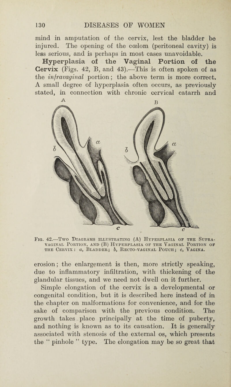 mind in amputation of the cervix, lest the bladder be injured. The opening of the coelom (peritoneal cavity) is less serious, and is perhaps in most cases unavoidable. Hyperplasia of the Vaginal Portion of the Cervix (Figs. 42, B, and 43).—This is often spoken of as the infravaginal portion; the above term is more correct. A small degree of hyperplasia often occurs, as previously stated, in connection with chronic cervical catarrh and A B Fig. 42.—Two Diagrams illustrating (A) Hyperplasia of the Supra¬ vaginal Portion, and (B) Hyperplasia of the Vaginal Portion of the Cervix: a, Bladder; b, Recto-vaginal Pouch; c, Vagina. erosion; the enlargement is then, more strictly speaking, due to inflammatory infiltration, with thickening of the glandular tissues, and we need not dwell on it further. Simple elongation of the cervix is a developmental or congenital condition, but it is described here instead of in the chapter on malformations for convenience, and for the sake of comparison with the previous condition. The growth takes place principally at the time of puberty, and nothing is known as to its causation. It is generally associated with stenosis of the external os, which presents the “ pinhole type. The elongation may be so great that