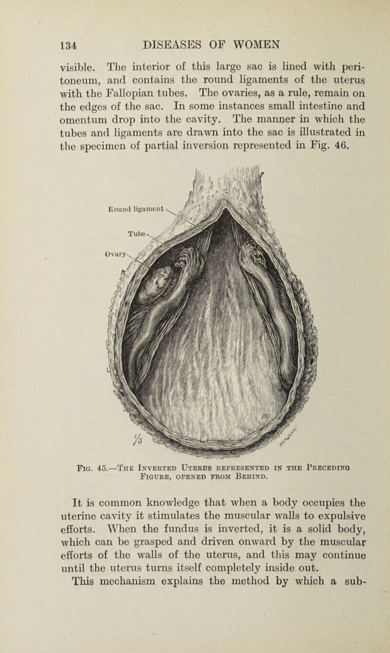 visible. The interior of this large sac is lined with peri¬ toneum, and contains the round ligaments of the uterus with the Fallopian tubes. The ovaries, as a rule, remain on the edges of the sac. In some instances small intestine and omentum drop into the cavity. The manner in which the tubes and ligaments are drawn into the sac is illustrated in the specimen of partial inversion represented in Fig. 46. Fig. 45.—The Inverted Uterus represented in the Preceding Figure, opened from Behind. It is common knowledge that when a body occupies the uterine cavity it stimulates the muscular walls to expulsive efforts. When the fundus is inverted, it is a solid body, which can be grasped and driven onward by the muscular efforts of the walls of the uterus, and this may continue until the uterus turns itself completely inside out. This mechanism explains the method by which a sub-